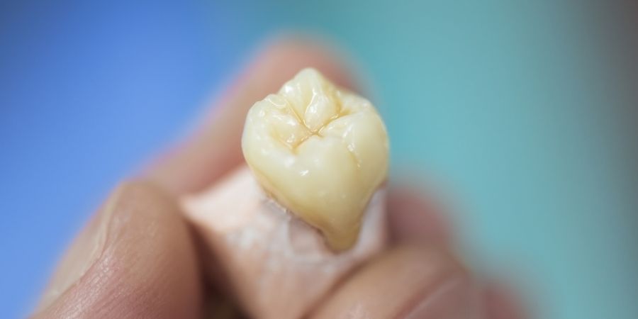 Implantes Dentales en Torrepacheco
