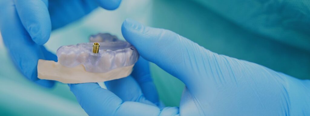fracaso de los implantes dentales