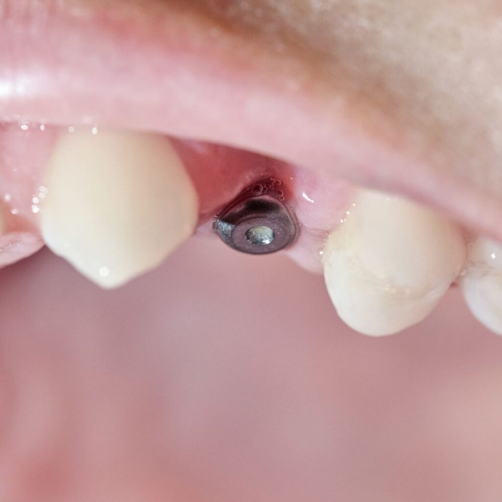 Sangrado después de los implantes dentales